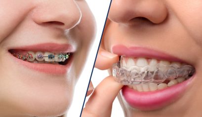 Invisalign Orthodontic Treatment Zurich